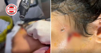 Criança é atendida após acidente com anzol no rosto durante pescaria em Luziânia